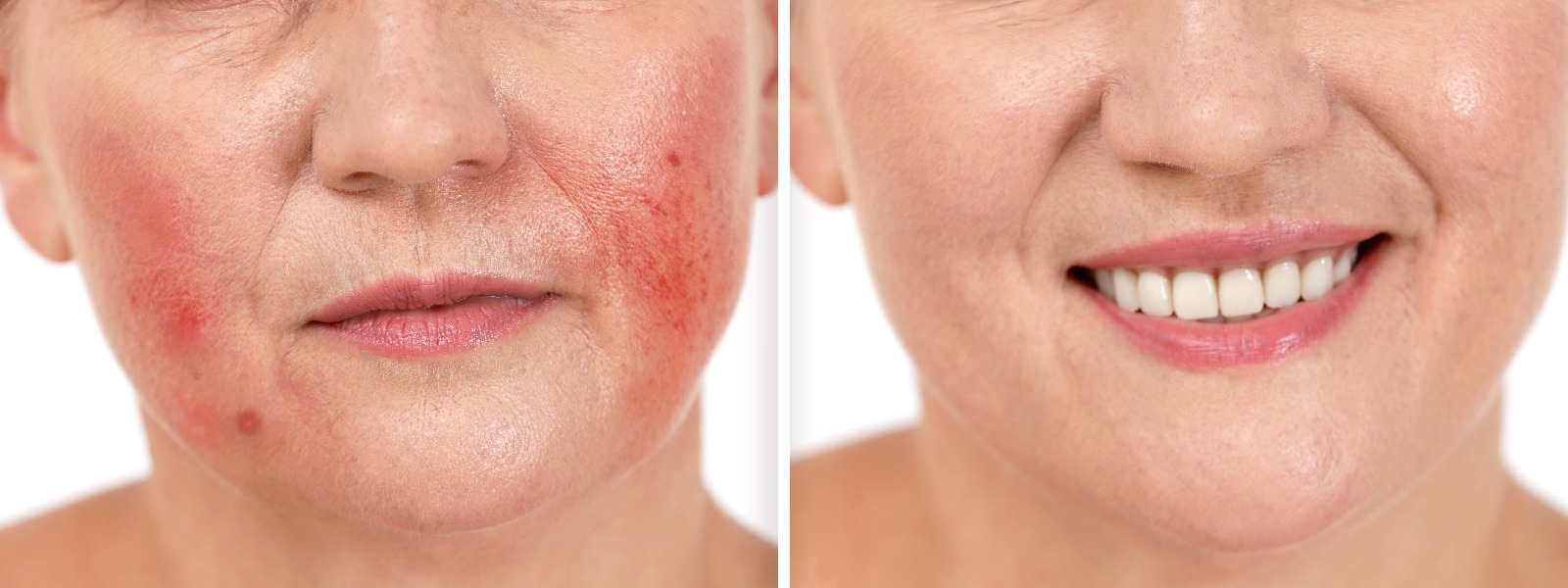 Vor und nach der Rosazea-Behandlung. Fotos einer Frau vor weißem Hintergrund, Nahaufnahme. Collage, die betroffene und gesunde Haut zeigt.